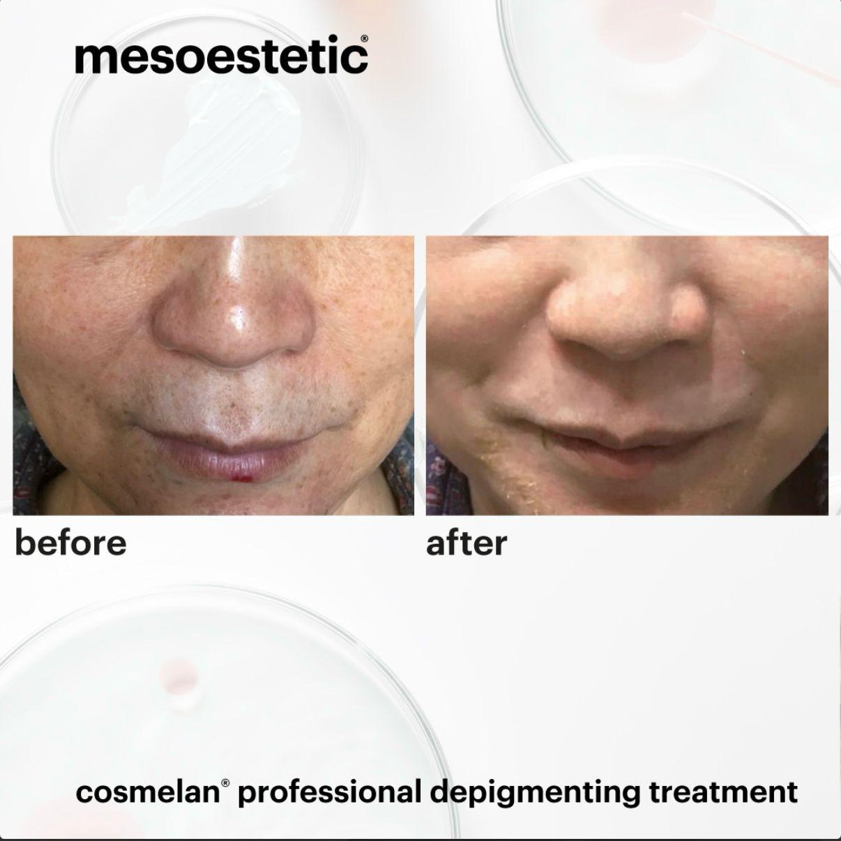 Cosmelan (1)
