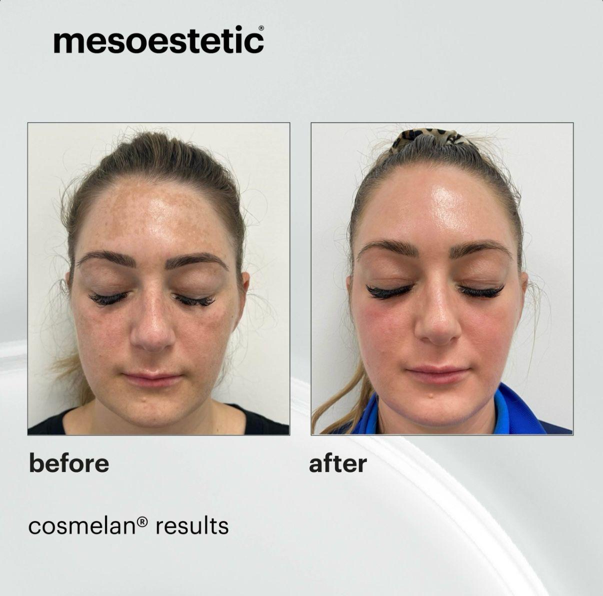 Cosmelan (2)